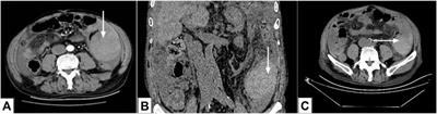 Case Report: Spontaneous Intramural Hematoma of the Colon Secondary to Low Molecular Weight Heparin Therapy